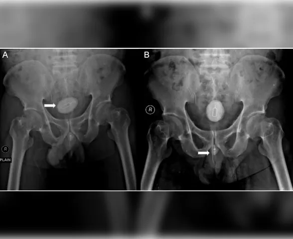 Homem passa por cirurgia após tentar retirar chip no pênis