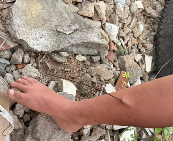 Criança fica ferida após ter perna perfurada por vergalhão