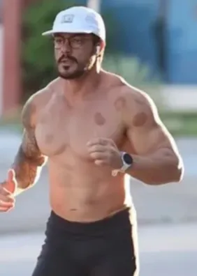 Atleta atropelado em Arapiraca passa por reconstrução no rosto e fará novas cirurgias