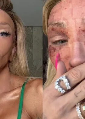 Maya Massafera atualiza estado de saúde e choca ao mostrar rosto: ‘Não consigo rir’