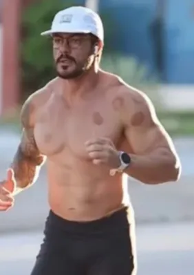 Atleta atropelado em Arapiraca passa por reconstrução no rosto e fará novas cirurgias