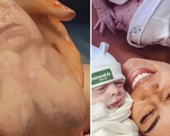 Bebê nasce dentro da bolsa amniótica e 'faz pose' durante parto