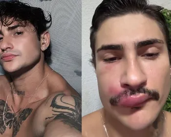 Influenciador ‘Ken de CG’ é internado após espremer espinha no rosto e faz alerta