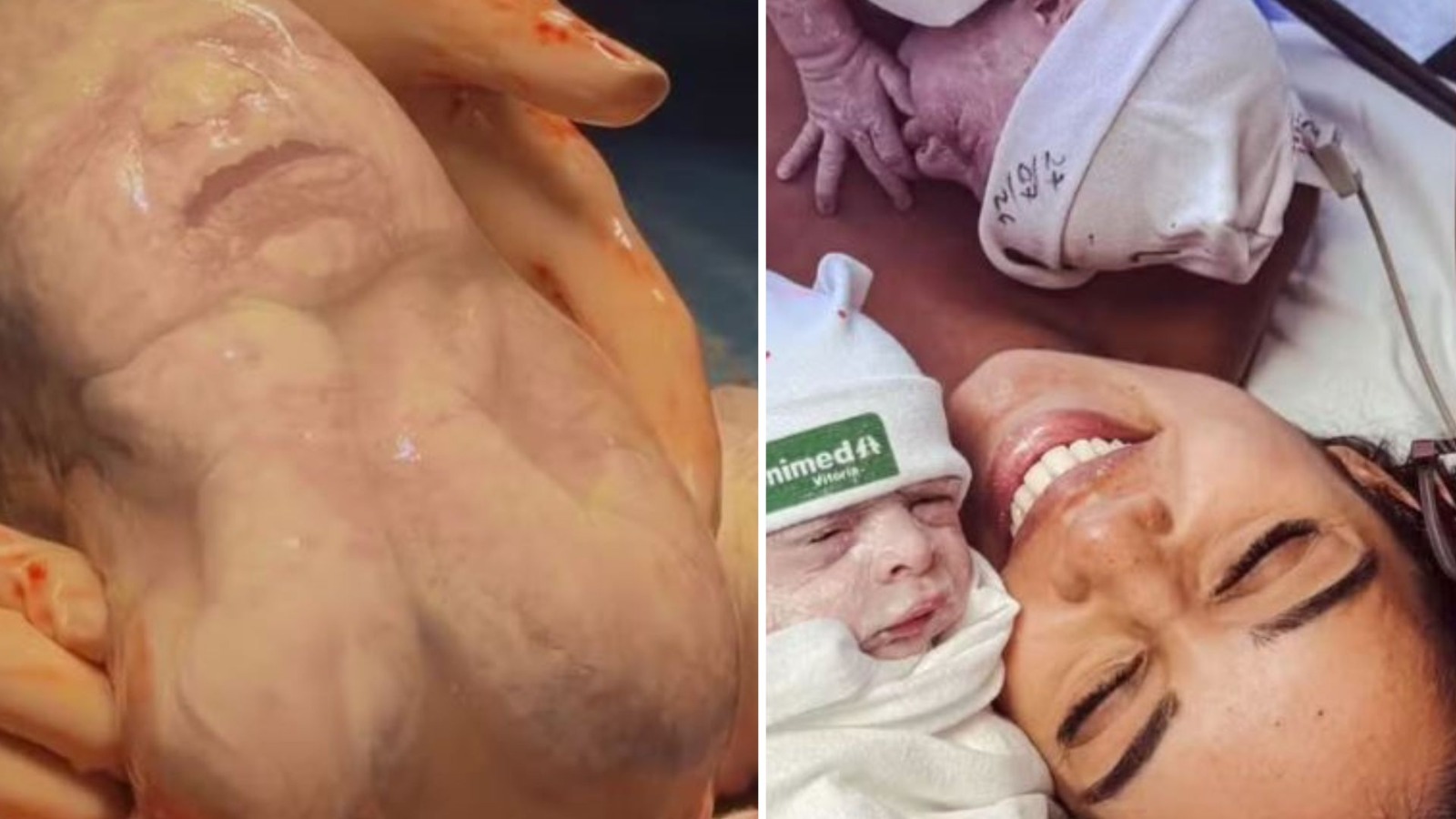 Bebê nasce dentro da bolsa amniótica e 'faz pose' durante parto
