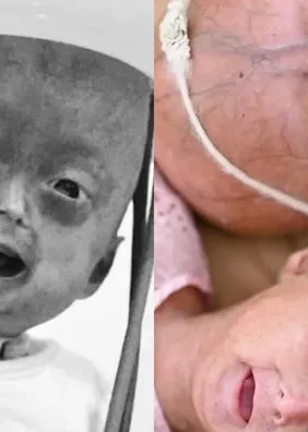 Morre Elis, influencer mirim com síndrome rara de envelhecimento precoce