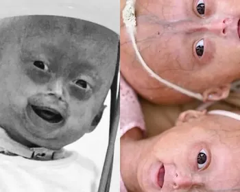 Morre Elis, influencer mirim com síndrome rara de envelhecimento precoce