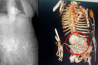 
			
				'Bebê de pedra': idosa descobre feto calcificado que carregou por anos
			
			