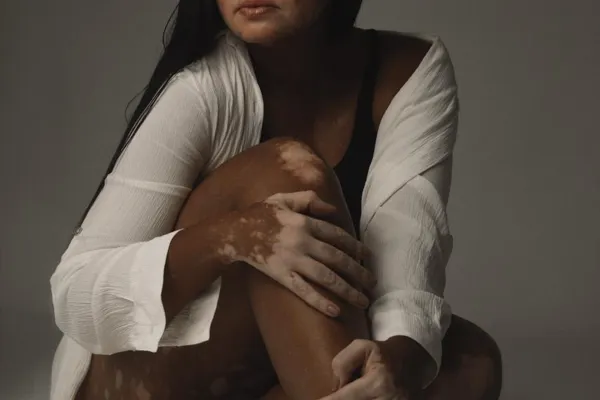 
				
					Vitiligo: o longo caminho do diagnóstico até a autoaceitação
				
				