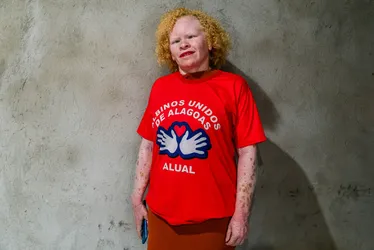 
			
				Alagoana transforma experiências em conhecimento para ajudar albinos
			
			