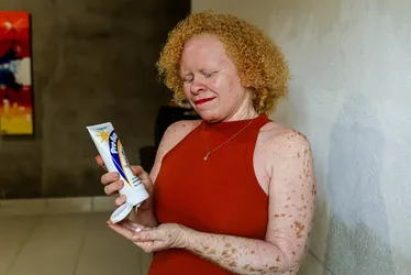 
			
				Alagoana transforma experiências em conhecimento para ajudar albinos
			
			