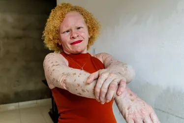 
			
				Alagoana transforma experiências em conhecimento para ajudar albinos
			
			