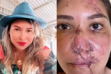 
			
				Após acidente de moto, mulher faz 4 cirurgias para reconstruir a face
			
			
