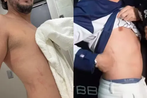 
				Nattan mostra machucados após se jogar no meio do público em show
			
			