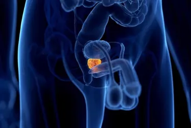 
			
				Hiperplasia prostática: saiba sintomas de quadro confundido com câncer
			
			