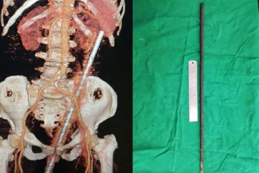 
			
				Mulher fica empalada em ferro de 60 cm após cair em pasto
			
			