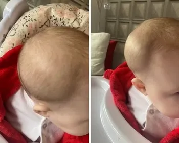 Mãe descobre fratura no crânio da filha ao buscá-la em creche