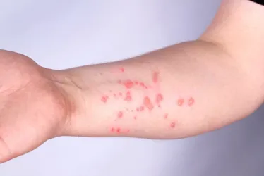 
				Mpox: moradora da Grande SP é o 1º caso de nova cepa da doença no país
			
			