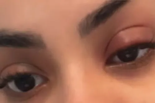 
				Lexa teve inchaço no olho e procurou ajuda médica dias antes de ser internada
			
			