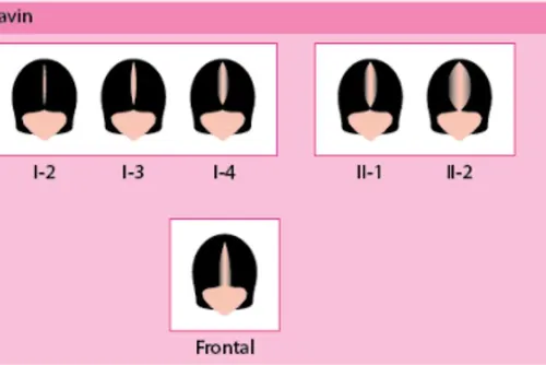 
				Você já percebeu seu cabelo afinando? Pode ser um sinal de calvície, e você nem imagina!
			
			