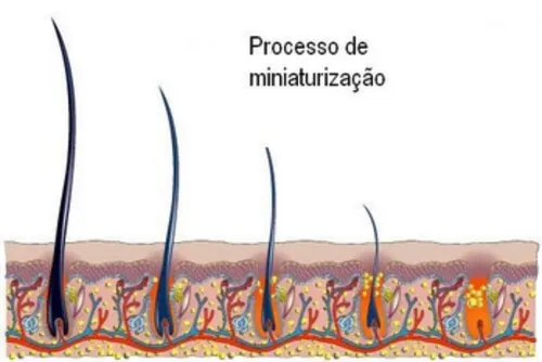 
				Você já percebeu seu cabelo afinando? Pode ser um sinal de calvície, e você nem imagina!
			
			