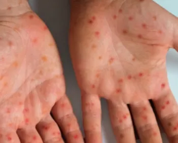 7 respostas para se proteger contra o sarampo, que volta a preocupar