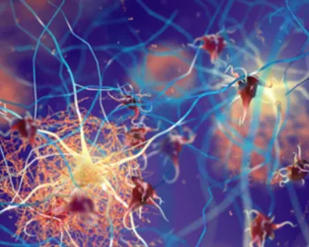 Conheça os prós e contras do novo medicamento para tratar casos de Alzheimer