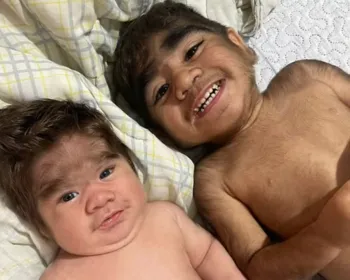 Influenciadora dá à luz segundo filho com "síndrome do lobisomem"