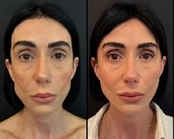 Jornalista alagoana revela resultado de cirurgia no rosto e fala sobre aparência natural