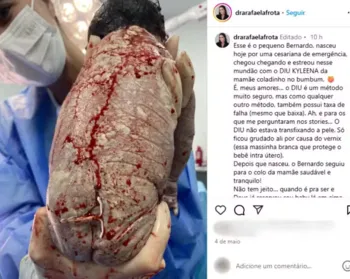 Mulher engravida com DIU e bebê nasce com dispositivo grudado nas costas no DF