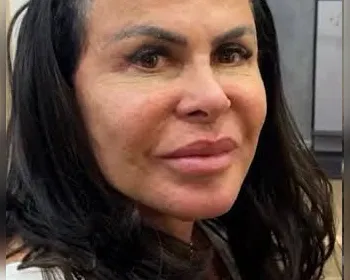 O que aconteceu com Gretchen? Especialista esclarece o procedimento