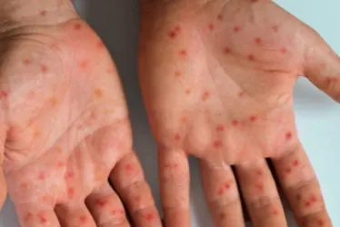 
			
				7 respostas para se proteger contra o sarampo, que volta a preocupar
			
			