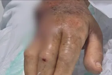 
			
				Idosa tem dedo e parte da mão amputados ao ser atacada por pitbull
			
			