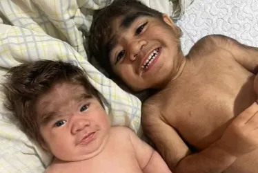 
			
				Influenciadora dá à luz segundo filho com "síndrome do lobisomem"
			
			