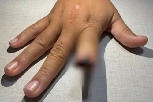 
				Homem arranca dedo de namorada a dentadas após briga e cospe no chão
			
			