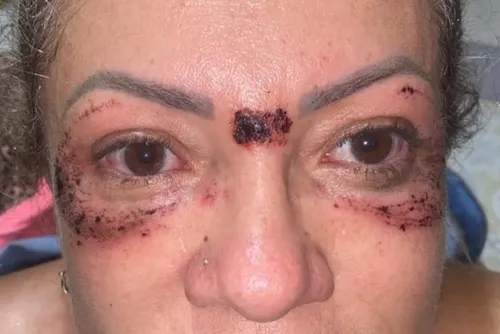 
				Mulher fica com buraco na testa após harmonização com biomédica
			
			