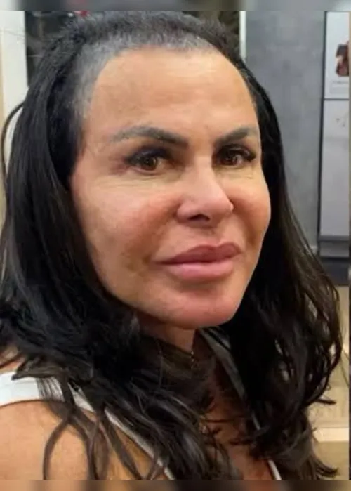
			
				O que aconteceu com Gretchen? Especialista esclarece o procedimento
			
			
