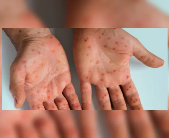 7 respostas para se proteger contra o sarampo, que volta a preocupar