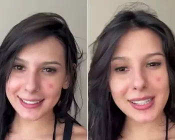 Roacutan contra acne: remédio usado por Ana Castela tem restrições