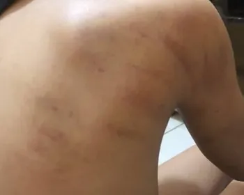 Chinelada e soco: menina é espancada por pai ao tomar Toddynho