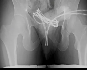 Homem é internado após enfiar cabo USB no pênis e objeto ficar preso