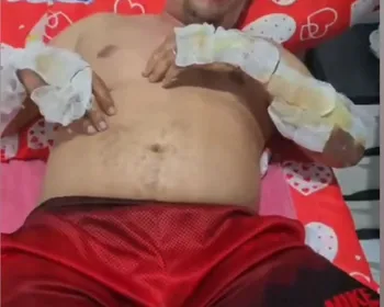Motorista de app queimado vivo fala pela primeira vez e pede ajuda: “Tou vivo por um milagre”