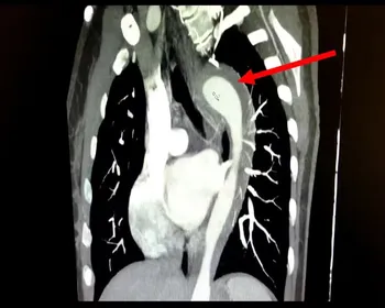 Mulher rompe aorta ao atingir o orgasmo: 'Dor intensa parecia facadas'