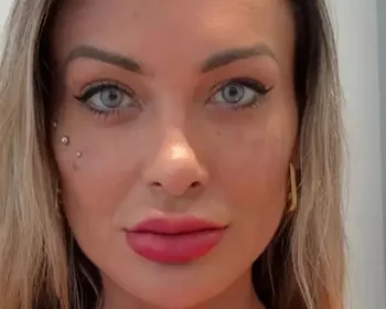Olhos claros, riscos ocultos: o que ninguém contou sobre a cirurgia de Andressa Urach