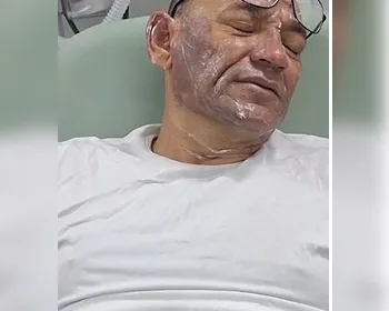 Sargento da PM é atingido com óleo quente no rosto ao prestar apoio à ocorrência com paciente psiquiátrico
