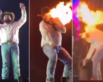 Sertanejo Léo mostra como ficou seu rosto após ser queimado em show