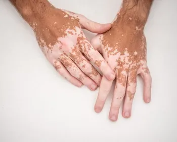 Vitiligo: entenda causas, sintomas e tratamento