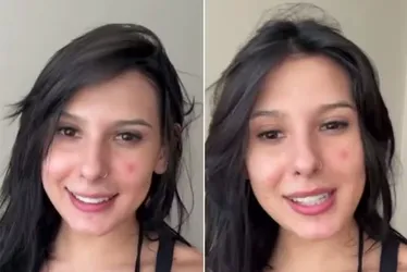 
			
				Ana Castela mostra rosto com acne e lamenta: 'Sofro há muitos anos'
			
			