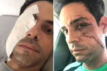 
			
				Empresário é agredido com copo de vidro e leva 62 pontos no rosto
			
			