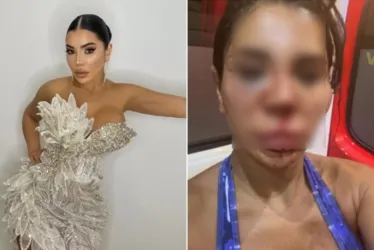 
				Influencer é torturada por horas e tem rosto desfigurado em assalto
			
			