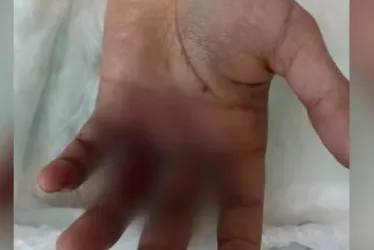 
			
				Jovem fica ferido após bolo explodir em suas mãos durante aniversário
			
			